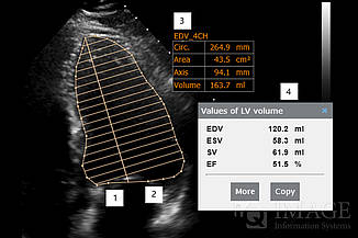 iQ-4VIEW ejection fraction